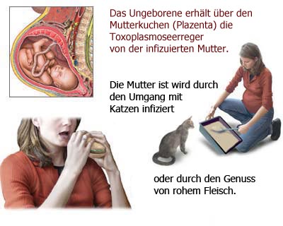 toxoplasmose